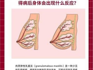 [乳房头被老嘴咬了肿了怎么办？]帕芙欧珍肤膏，快速消红肿